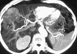 Hepatoma With Neovascularity - CTisus CT Scan