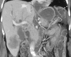 Invasive Gallbladder Cancer - CTisus CT Scan