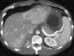 Hepatoma - CTisus CT Scan