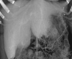 Enlarged Liver With Pruning of Venous Structures - CTisus CT Scan