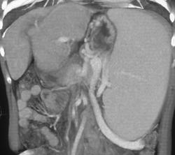 Cirrhosis With Awesome Varices - CTisus CT Scan