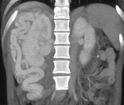 Large Varices Around the Kidney - CTisus CT Scan