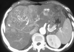 Hepatoma With Neovascularity - CTisus CT Scan