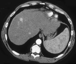 1 Cm Hepatoma - CTisus CT Scan