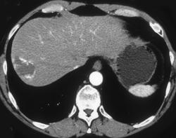 Hemangioma - CTisus CT Scan