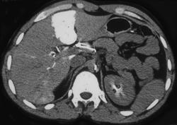 Flow Changes in Liver With Hot Spot Due to SVC Occlusion - CTisus CT Scan