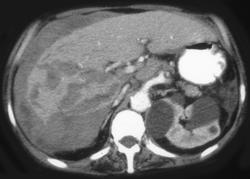 Spontaneous Hepatic Bleed Several Hours Post Liver Biopsy - CTisus CT Scan