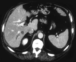 Focal Duct Dilatation in Right Lobe of Liver With Resultant Thad Defect - CTisus CT Scan