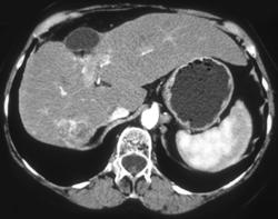 Hepatoma - CTisus CT Scan