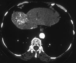 Hepatoma With Neovascularity - CTisus CT Scan