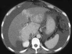 IVC Clot and Budd-Chiari Syndrome - CTisus CT Scan