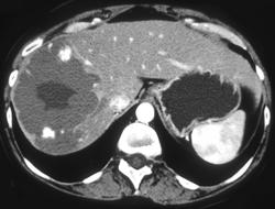 Giant Cavernous Hemangioma - CTisus CT Scan