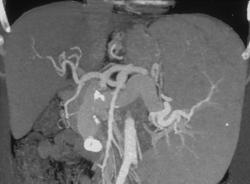 Cirrhosis With Portal Hypertension and Patent Superior Mesenteric Vein (SMV)-IVC Shunt - CTisus CT Scan