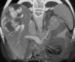 Giant Cavernous Hemangioma - CTisus CT Scan