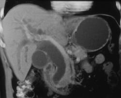 3D of Dilated Common Bile Duct - CTisus CT Scan