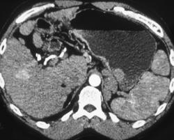 Cirrhosis With Occult Hepatomas - CTisus CT Scan