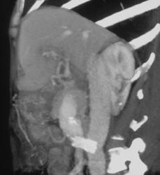 Patent Meso-caval Shunt - CTisus CT Scan