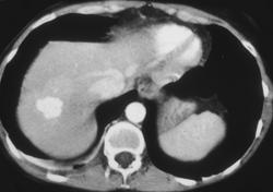 Hemangioma (atypical) - CTisus CT Scan