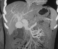 Aneurysm of the Portal Vein - CTisus CT Scan