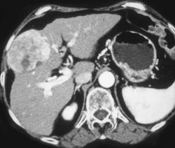 Hepatoma - CTisus CT Scan