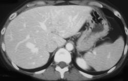 Focal Nodular Hyperplasia - CTisus CT Scan