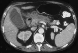 Acute Cholecystitis and Acute Pancreatitis - CTisus CT Scan