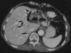 Oriental Cholangitis - CTisus CT Scan