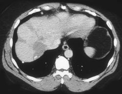 Multiple Hemangiomas - CTisus CT Scan