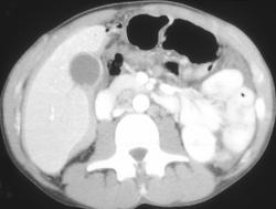 Blood Around Liver Edge Is Hard to See on Arterial Phase Scan - CTisus CT Scan