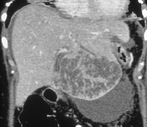 Hepatoma - CTisus CT Scan