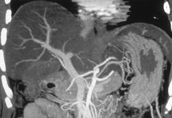 Gastritis Due to Cirrhosis - CTisus CT Scan