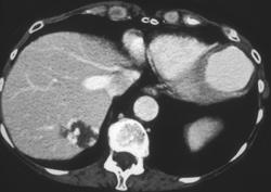 Hemangioma - CTisus CT Scan