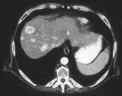 Metastatic Renal Cell Carcinoma (vascular) - CTisus CT Scan