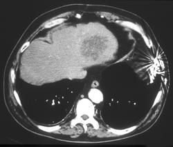 Angiosarcoma in Left Lobe of Liver - CTisus CT Scan