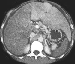 Fatty Liver With Areas of Focal Sparing - CTisus CT Scan