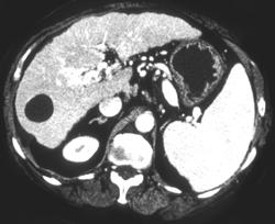 Hepatic Cyst in A Cirrhotic Liver - CTisus CT Scan