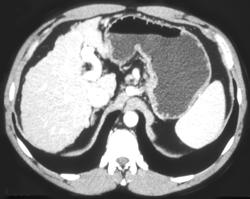 Cirrhosis - CTisus CT Scan