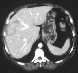 Hepatic Adenoma - CTisus CT Scan