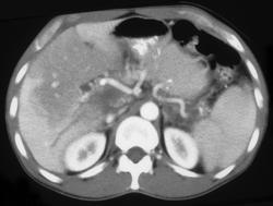 Portal Vein Thrombosis With Flow Changes in the Liver - CTisus CT Scan