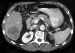 Hepatoma With Gallbladder Varices - CTisus CT Scan