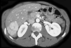 Focal Nodular Hyperplasia (FNH) - CTisus CT Scan