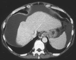 Cirrhosis With Incidental Hepatoma on Arterial Phase. Venous Phase Normal - CTisus CT Scan