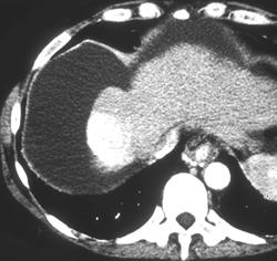 Hepatoma - CTisus CT Scan