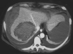 Hepatic Bleed and Subcapsular Bleed Due to Metastatic Testicular Cancer - CTisus CT Scan