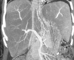 Amyloidosis of the Liver - CTisus CT Scan