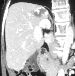 Hemangioma - CTisus CT Scan