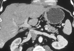 Hepatoma in Tip of Right of Liver - CTisus CT Scan