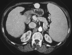 Cirrhosis With Huge Umbilical Vein - CTisus CT Scan