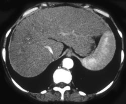 Cirrhosis Seen Best on Venous Phase - CTisus CT Scan