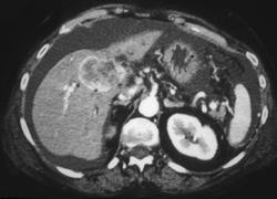 Hepatoma - CTisus CT Scan